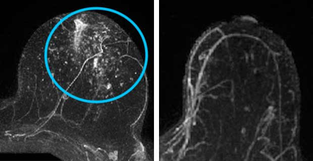 Добавочная долька молочной железы на маммографии фото и описание